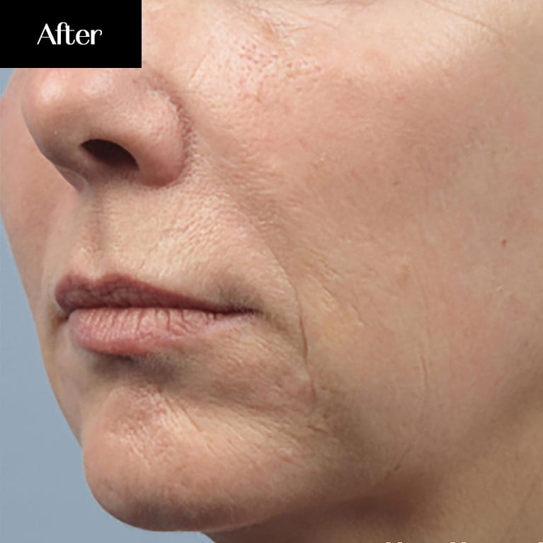 Jowls After Treatment