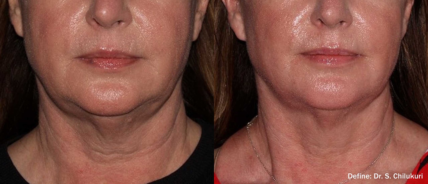 Define Before and After Treatment